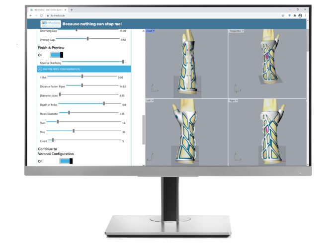 Hand mit 3d-gedruckter Orthese Orthimale